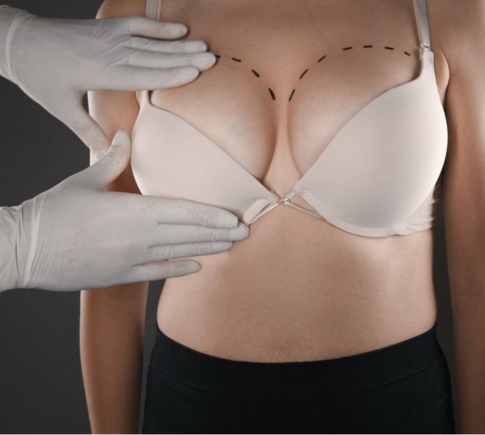 Silicone Breast Implants in Vancouver, BC